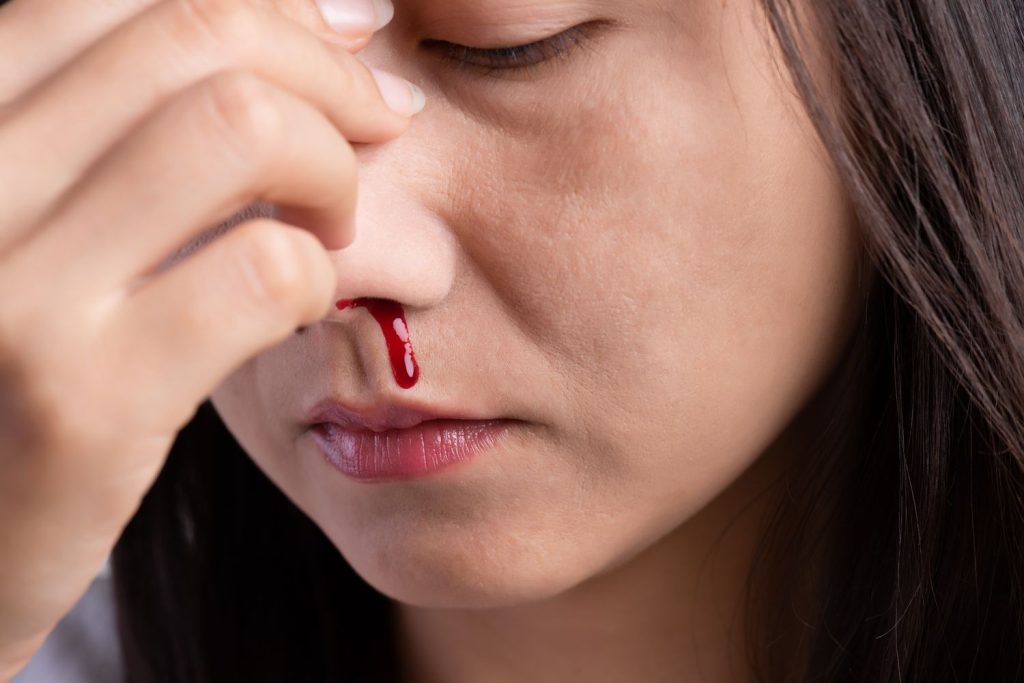 How to treat nosebleed