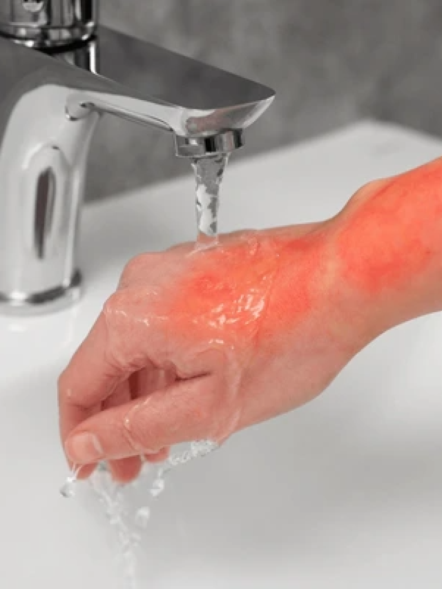 How to Treat Burns Effectively